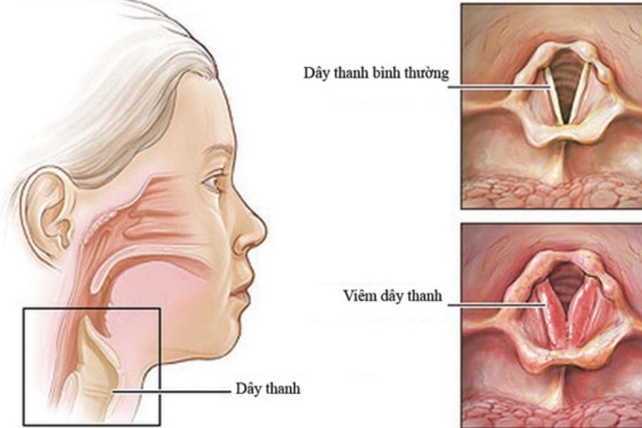 Bệnh viêm thanh quản lây qua đường nào?