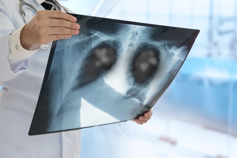 Nguyên nhân, dấu hiệu và cách phòng ngừa viêm phổi ở người lớn
